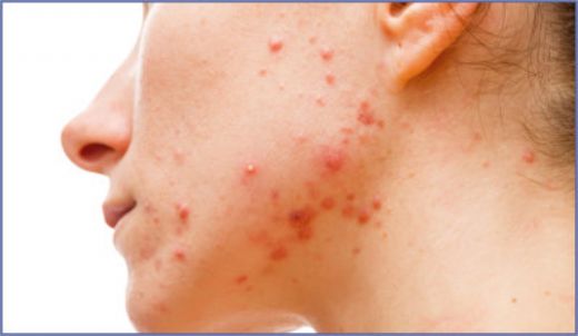 Sivilce Duası Okunuşu ve Anlamı